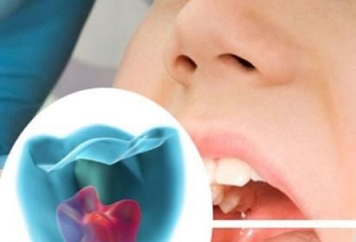 Endodoncia en San Sebastián de los Reyes