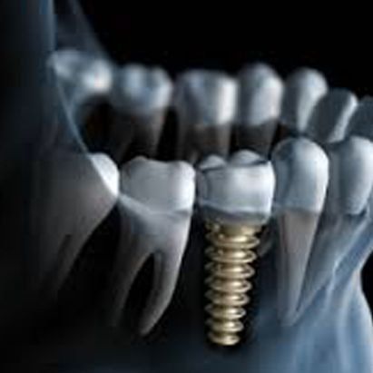 Implantes dentales en San Sebastián de los Reyes